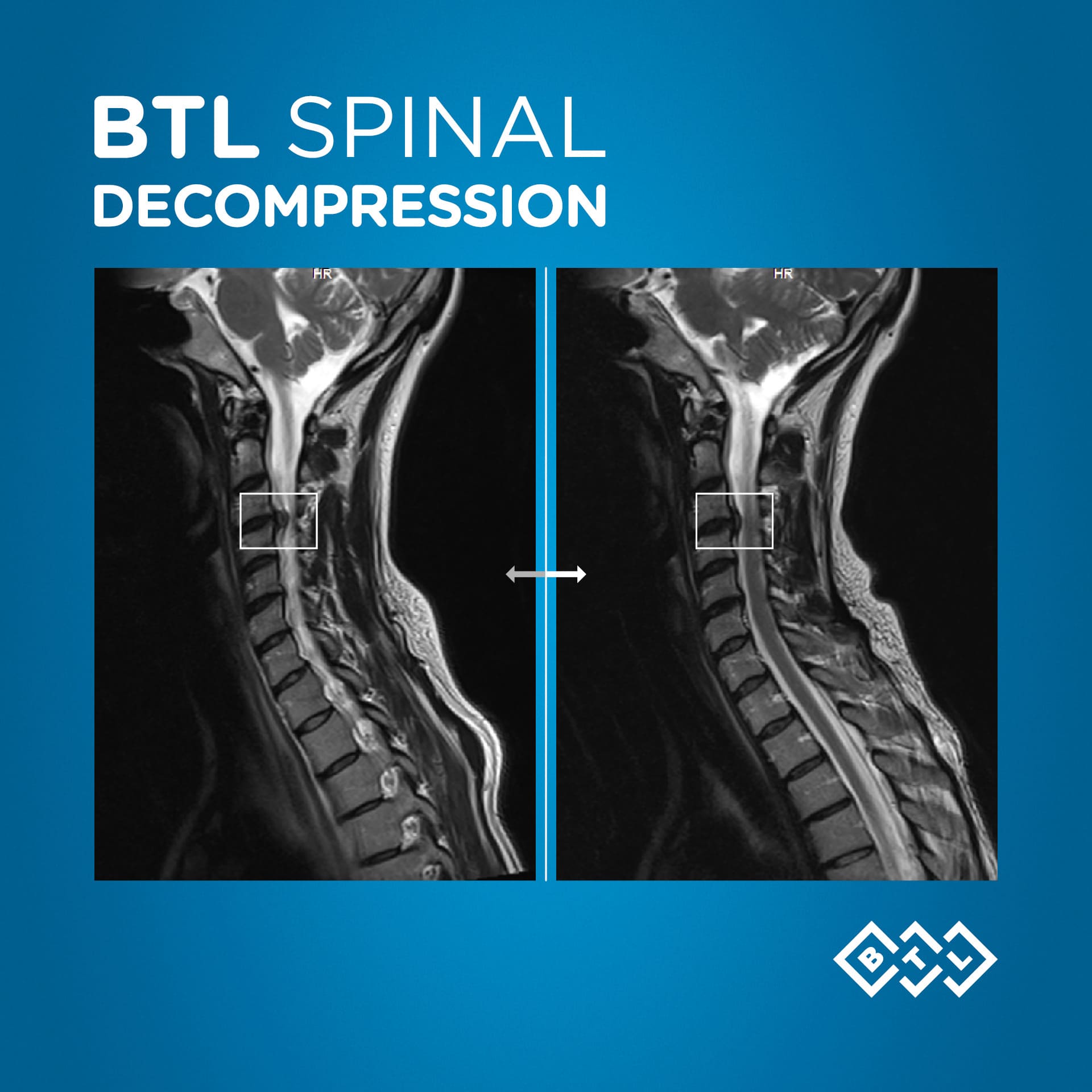 HERNIA DISCAL Y SU TRATAMIENTO INNOVADOR 5 Post-Tratamiento Sistema Descompresión Axial Hernia Cervical C2-C3(C)