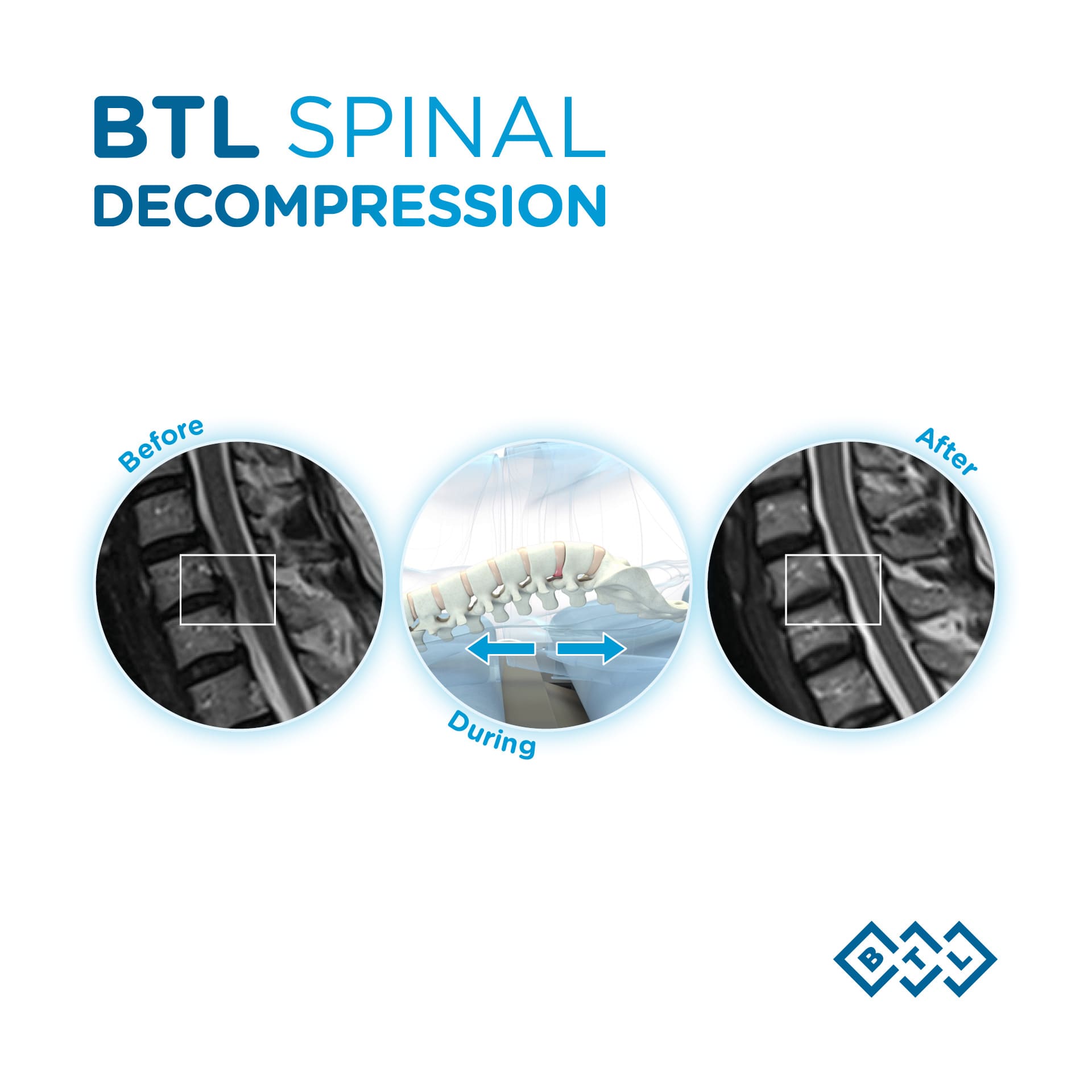 HERNIA DISCAL Y SU TRATAMIENTO INNOVADOR 2 El tratamiento de descompresión vertebral