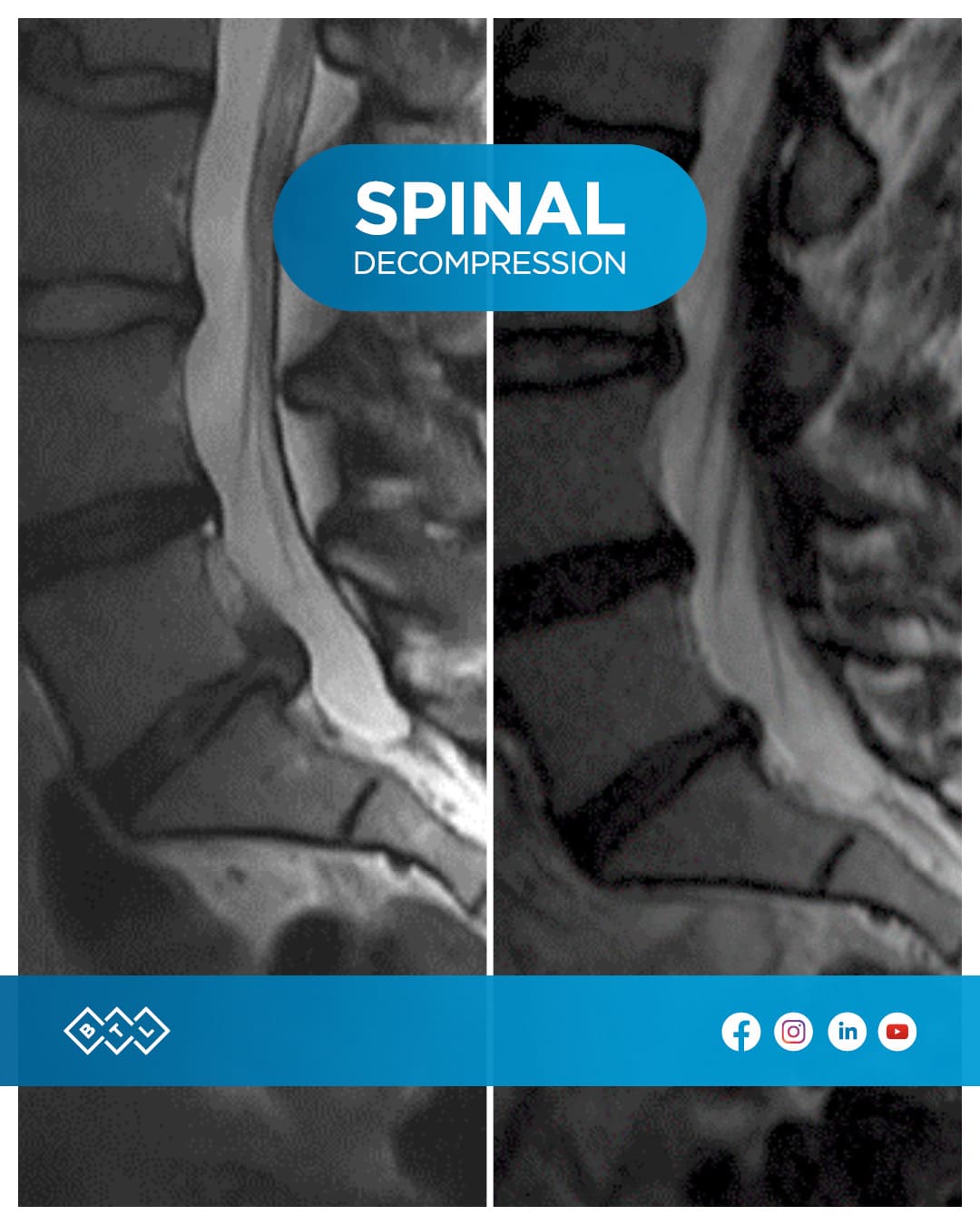 HERNIA DISCAL Y SU TRATAMIENTO INNOVADOR 3 Deslizado de disco L4-L5 hernia discal