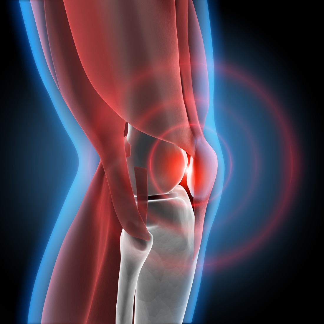 Dolor de Rodilla