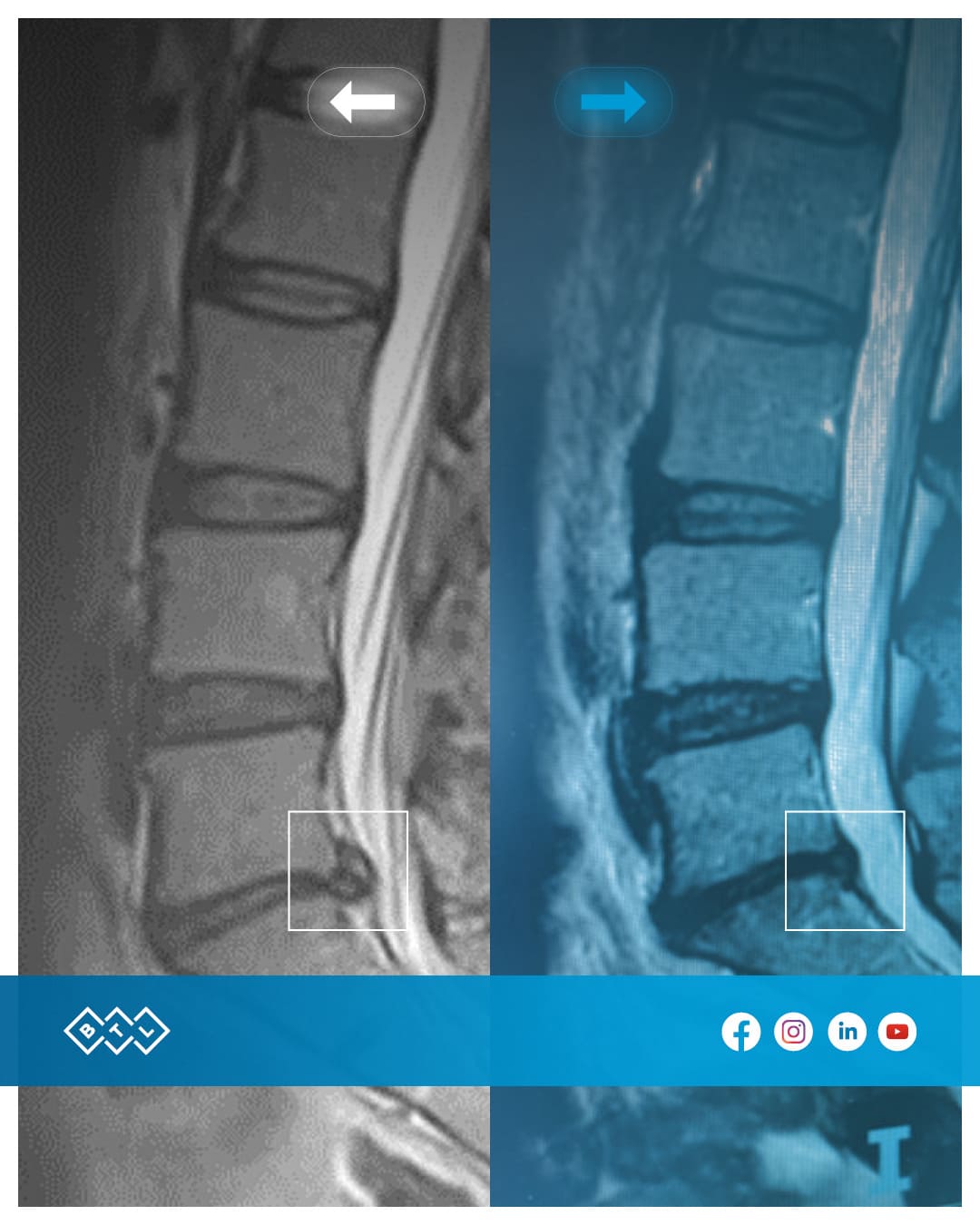 HERNIA DISCAL Y SU TRATAMIENTO INNOVADOR 4 15 sesiones de descompresión vertebral