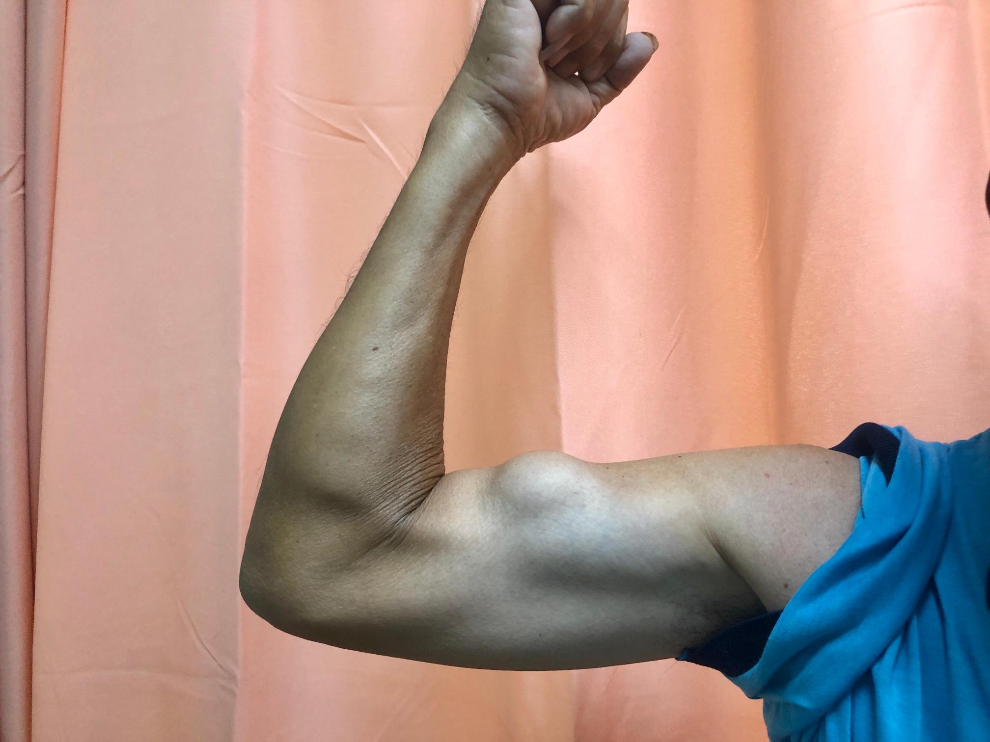 lesion brazo popeye